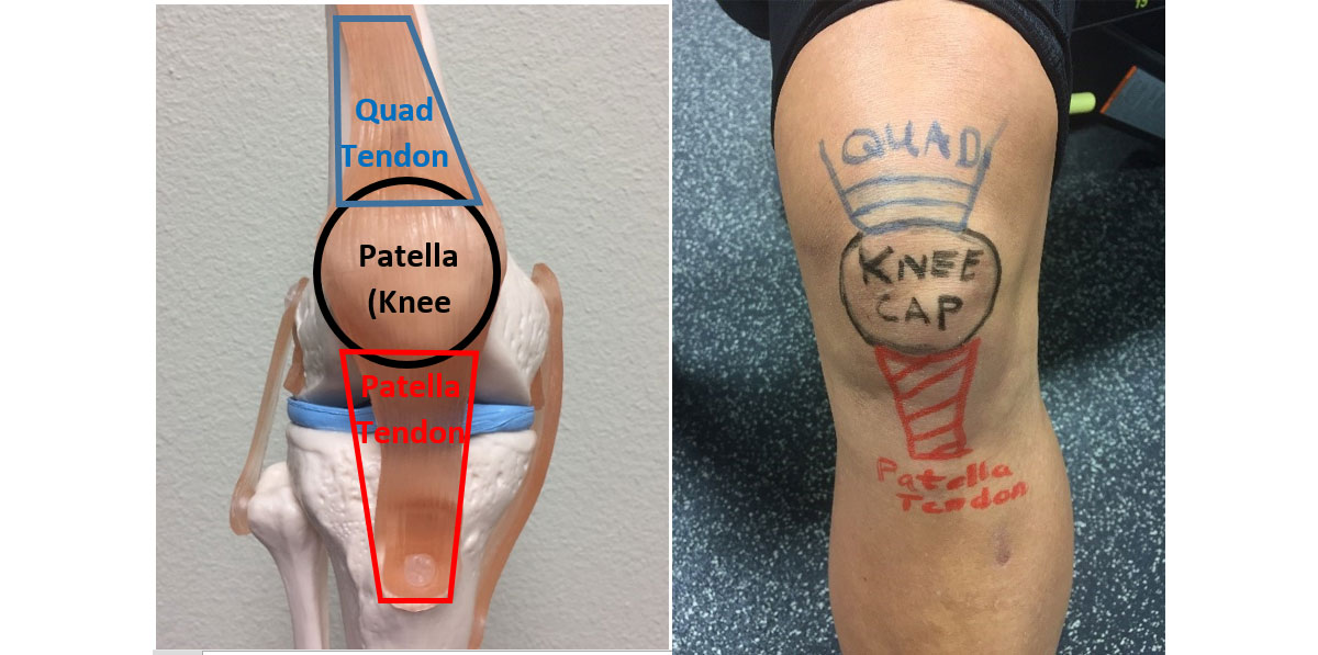 Where is patellar tendonitis pain located?