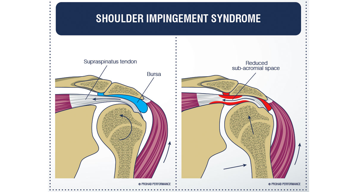 Shoulder Impingement Advanced Orthopaedic Specialists Fayetteville